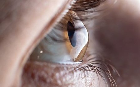 Laser LASIK Eye Surgery After Care Guide: Best Recovery Tips