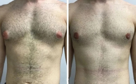 Laser vs. Traditional Surgery: Insights from the Best Gynecomastia Surgeon in Dubai