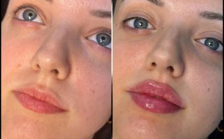 Get the Look You Want at the Best Aesthetic Clinics in Dubai for Fillers