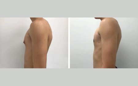 Role of the Best Gynecomastia Surgeons in Dubai in Your Recovery