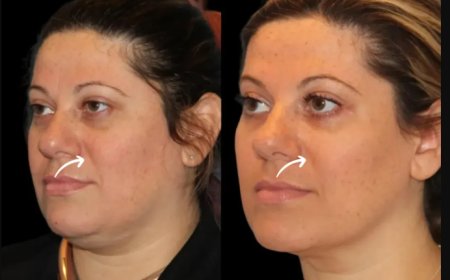 Sculptra Fillers Training: Years of Mastery by the Best Doctors in Dubai