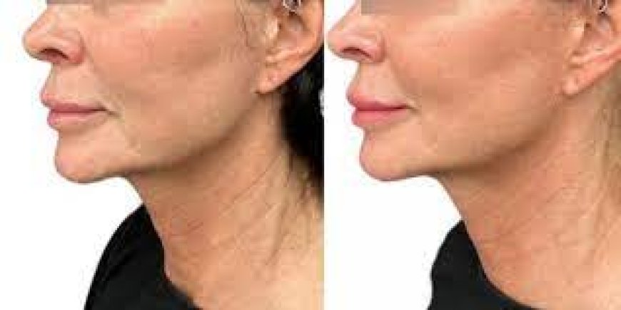 Best Plastic Surgeons in Dubai: How Long Do Thread Lifts Last and What Are the Results