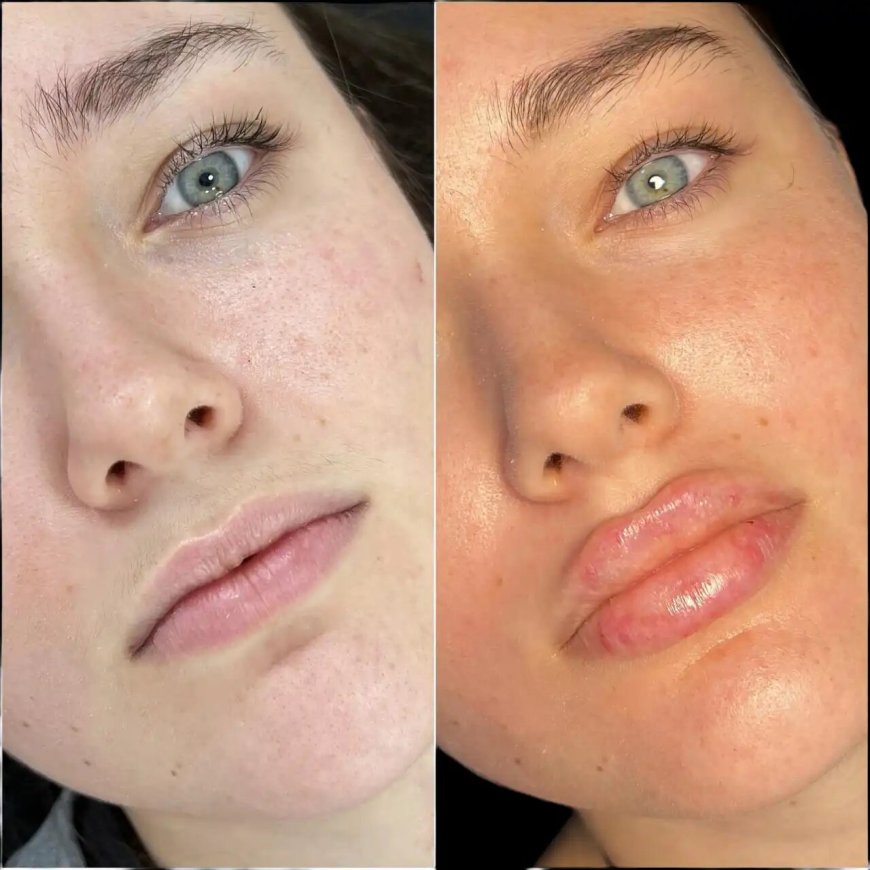 Best Plastic Surgeons in dubai for Non-Surgical Fillers Enhancement