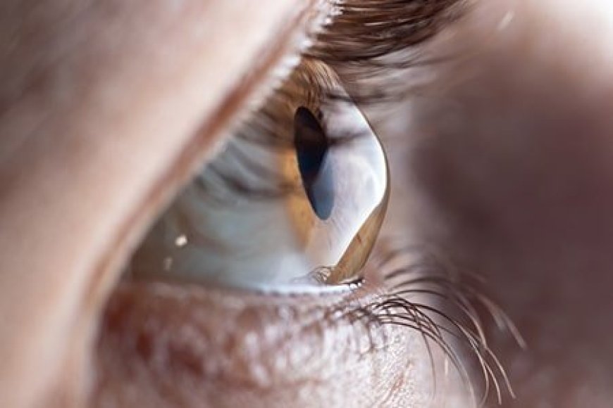 Laser LASIK Eye Surgery After Care Guide: Best Recovery Tips