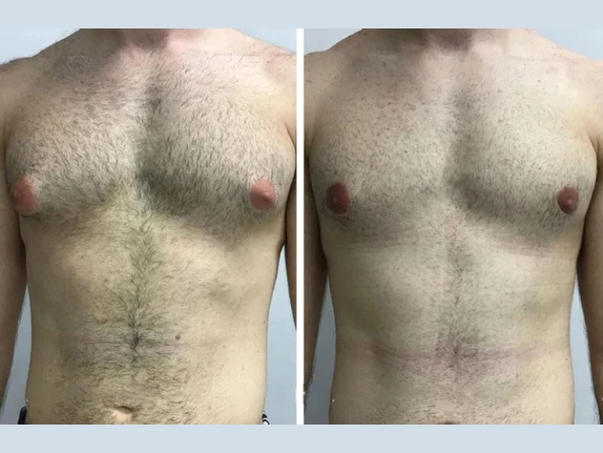 Laser vs. Traditional Surgery: Insights from the Best Gynecomastia Surgeon in Dubai