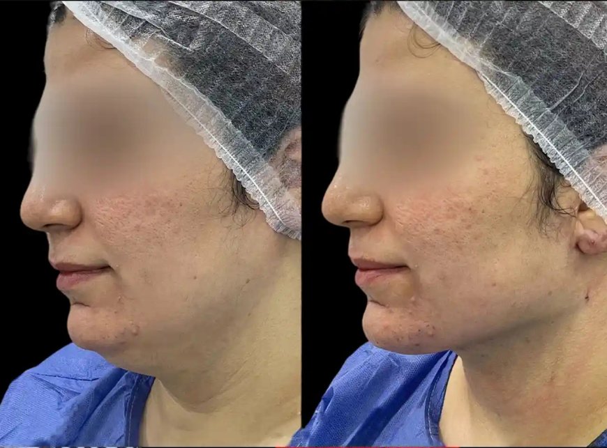 Best Plastic Surgeon in dubai for Chin Fillers: Can Improve Your Profile