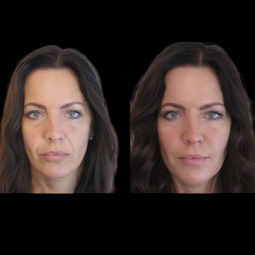 Best Plastic Surgeon in dubai forJawline Fillers: Enhancing Your Facial Balance with Ease