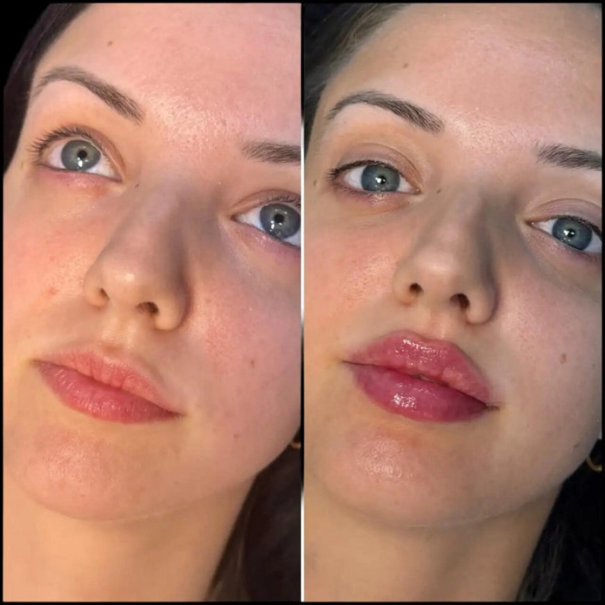 Best Plastic Surgeon in Dubai: How Fillers Can Improve Your Profile