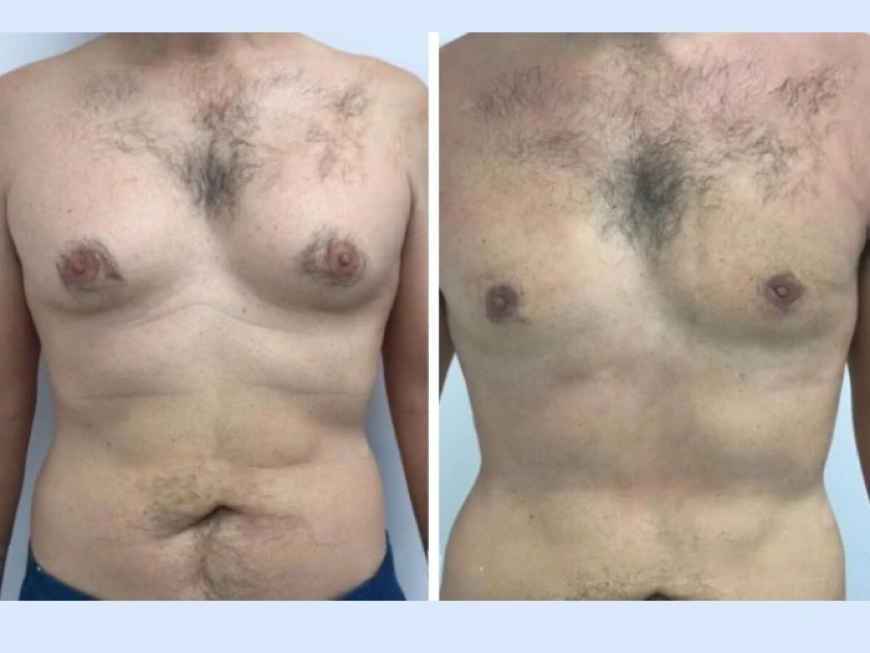 Best Gynecomastia Surgeons in Dubai: How to Ensure a Successful Male Breast Reduction