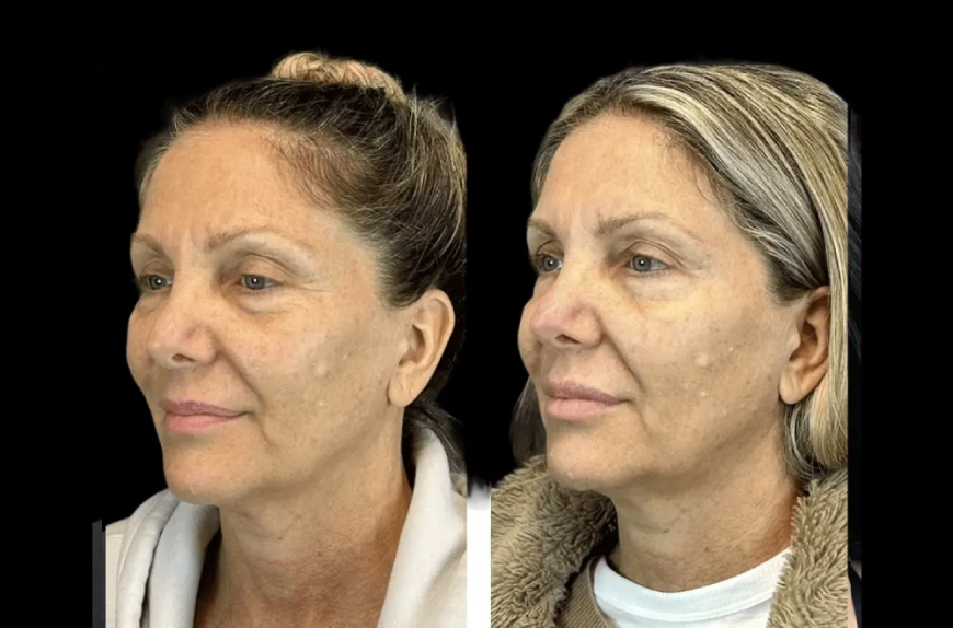 Seasonal Tips for Botox Treatment in Dubai: When Is the Best Time?
