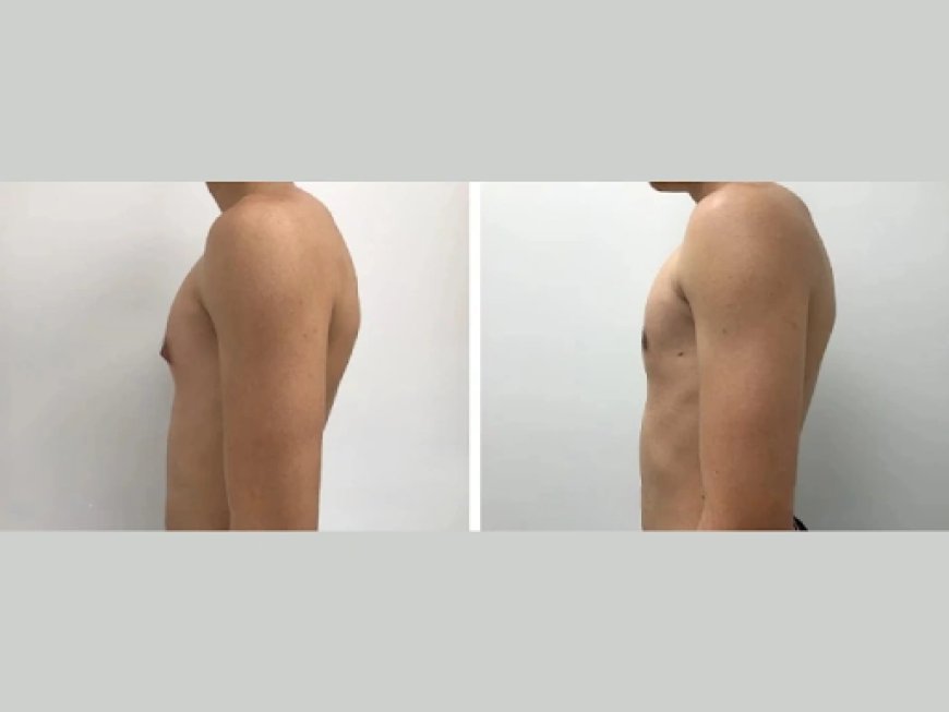 Psychological Impact of Gynecomastia in Men Living in Dubai