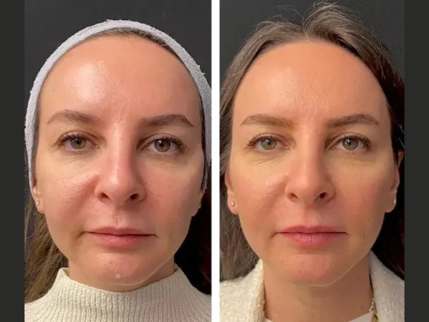 Why Choose the Best Doctors in Dubai for Your Mesotherapy Treatment?
