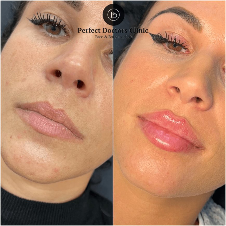 Juvederm for Jawline Definition: Tips from the Best Doctors in Dubai