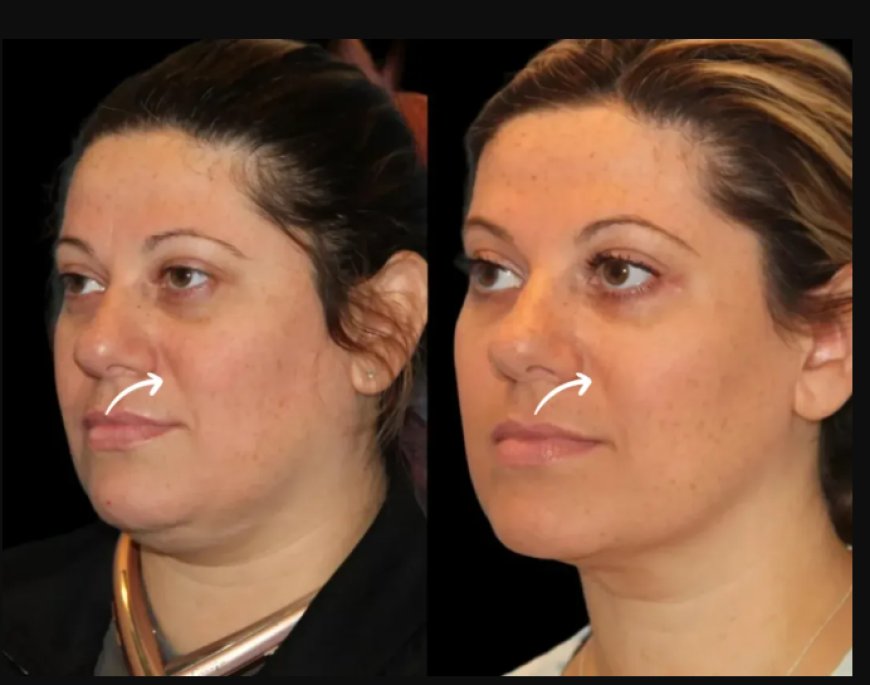 Sculptra Fillers Training: Years of Mastery by the Best Doctors in Dubai