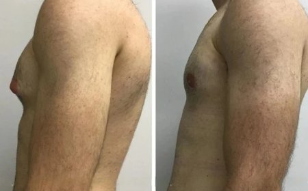 How to Prepare for Your Consultation on Gynecomastia in Dubai