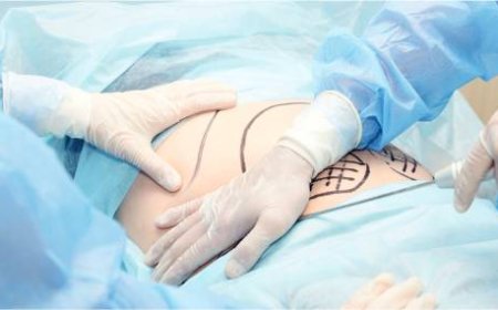 Tummy Tuck in Dubai: Achieve a Flatter, Toned Abdomen with Precision Surgery