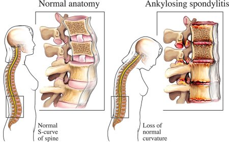 Brufen 400 mg for Dental Pain: From Toothache to Post-Extraction Comfort
