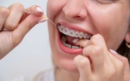 Types of Braces You May Not Have Thought to Ask About