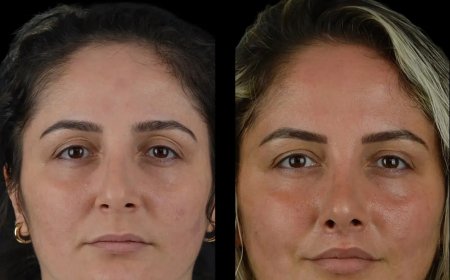 Best Plastic Surgeon in Dubai: Your First Step to Perfect Cheek Fillers