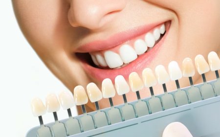 Veneers in Dubai: The Ultimate Guide to a Perfect Smile
