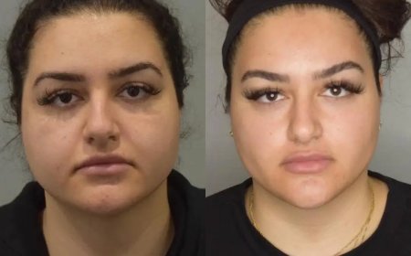 Buccal Fat Removal in Dubai and Facial Sculpting Trends