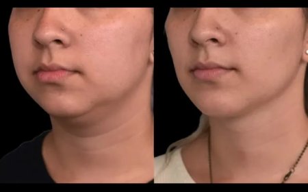 The Role of Ultrasound in Non-Invasive Double chin removal in Dubai