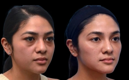 Dark Circles Treatment in Dubai: How Hydration Can Help Minimize Dark Circles