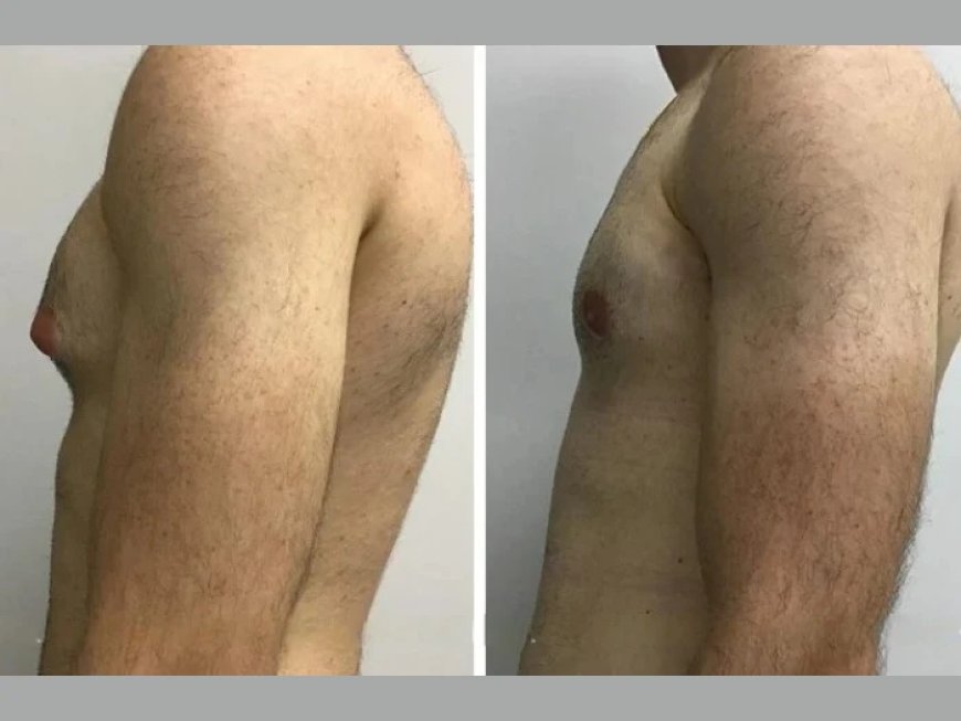 How to Prepare for Your Consultation on Gynecomastia in Dubai