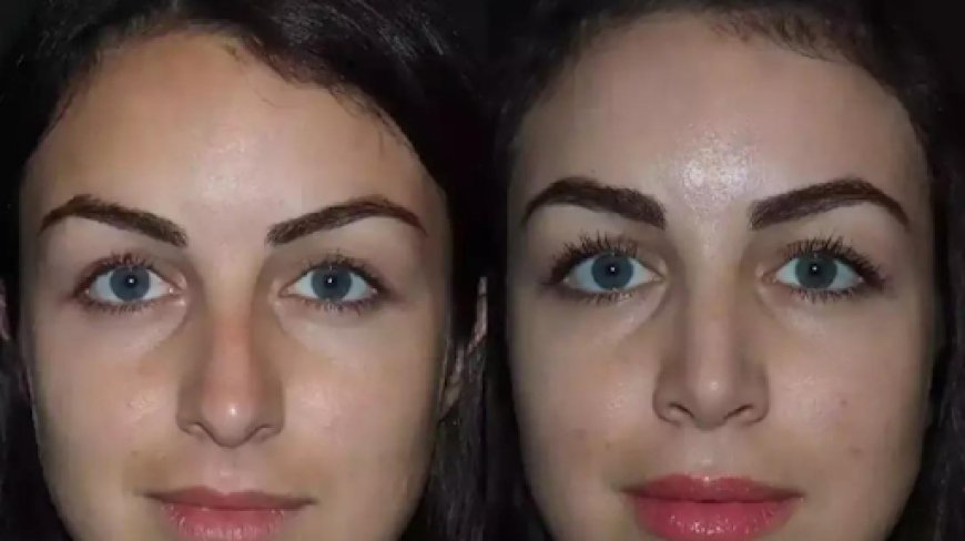 Combining Rhinoplasty in Dubai with Other Facial Procedures