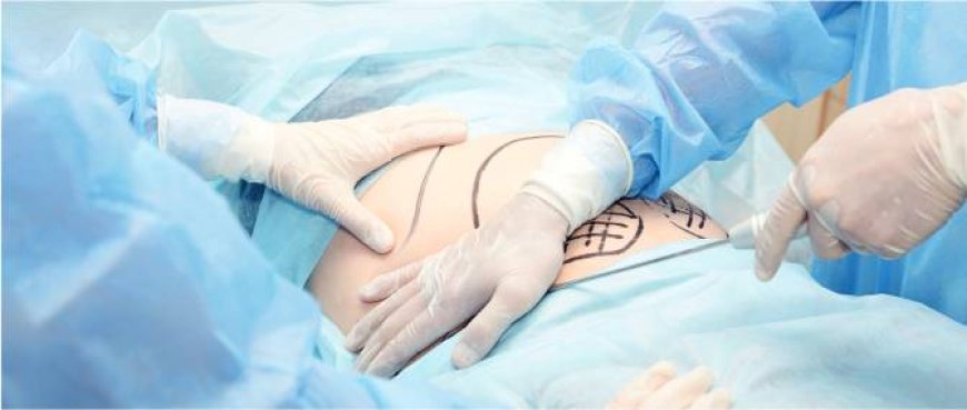 Tummy Tuck in Dubai: Achieve a Flatter, Toned Abdomen with Precision Surgery