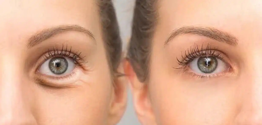 Skin Boosters in Bangalore: Are They the Secret to Fresher, Healthier Skin?