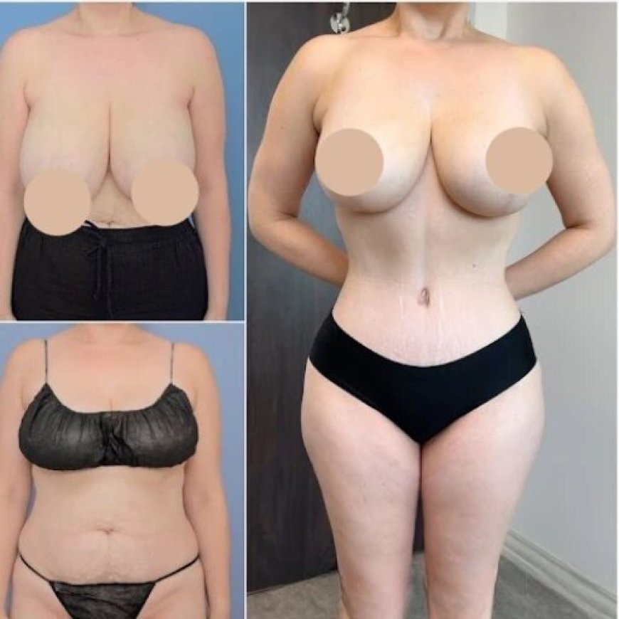 How to Select the Best Tummy Tuck Surgeon in Dubai for Safe and Effective Surgery