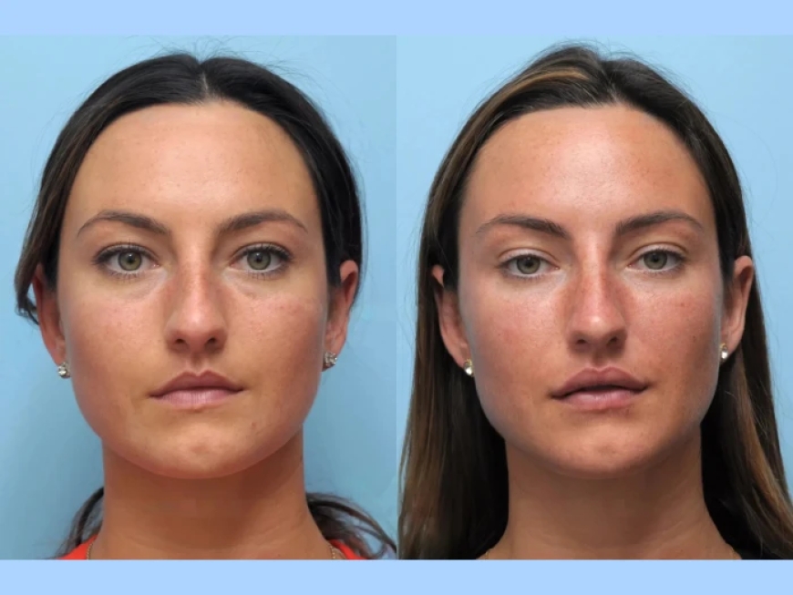 Where to Find the Best Aesthetic Clinics in Dubai for Thread Lift Expertise