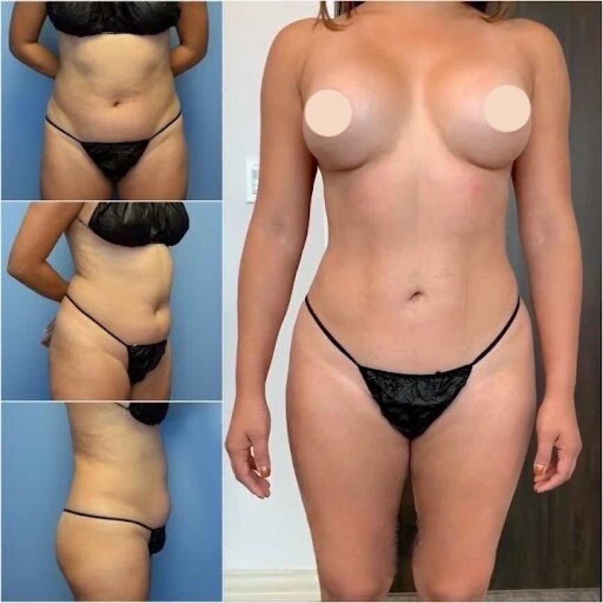 Achieve Perfect Results with the Best Body Contouring Surgeon in Dubai