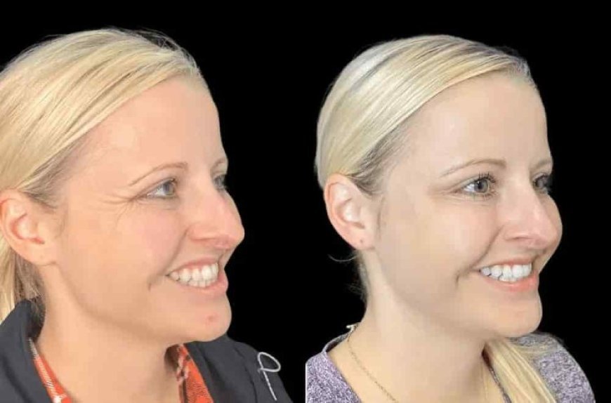 Smooth Your Skin at the Best Aesthetic Clinics in Dubai for Botox
