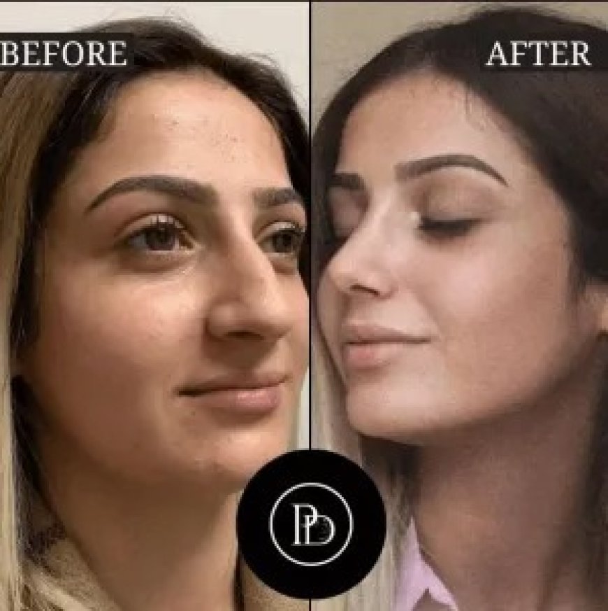 Top Dermatologists Recommend PRP Treatment in Dubai