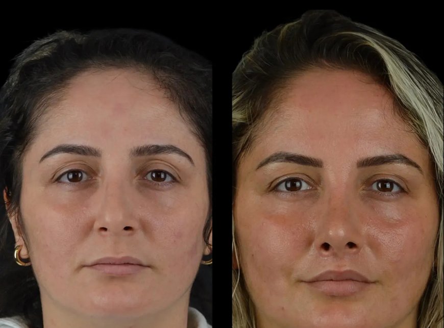 Best Plastic Surgeon in Dubai: Your First Step to Perfect Cheek Fillers