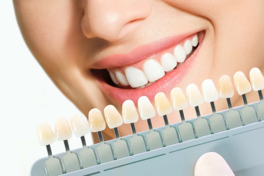 Veneers in Dubai: The Ultimate Guide to a Perfect Smile