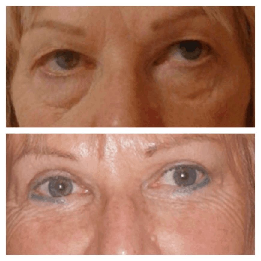 Celebrities choosing Eye bag removal in Dubai in 2025