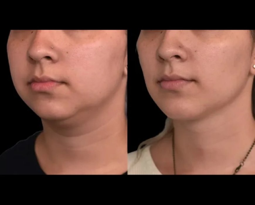 The Role of Ultrasound in Non-Invasive Double chin removal in Dubai