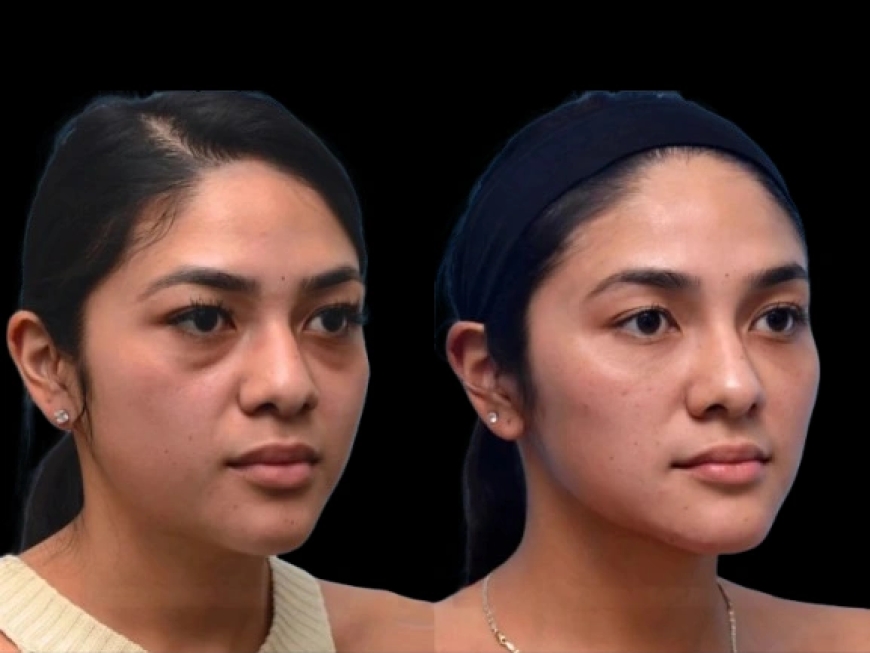 Dark Circles Treatment in Dubai: How Hydration Can Help Minimize Dark Circles